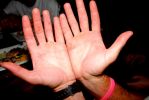 13 Dammage to the hands of one of the crew